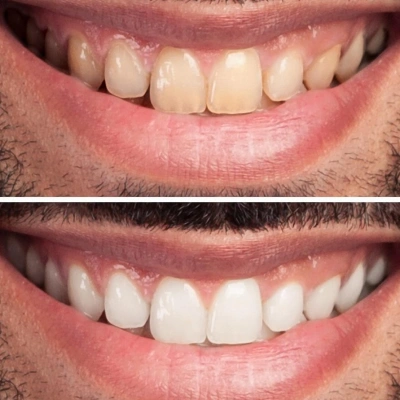 Beautiful smile transformation at Dr. Kisan Dental Clinic